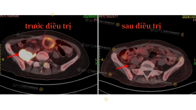 腹膜后肿瘤-治疗对比_副本.png