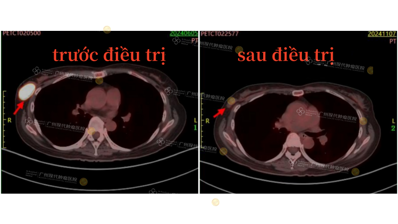 右胸壁肿瘤治疗前后_副本.png