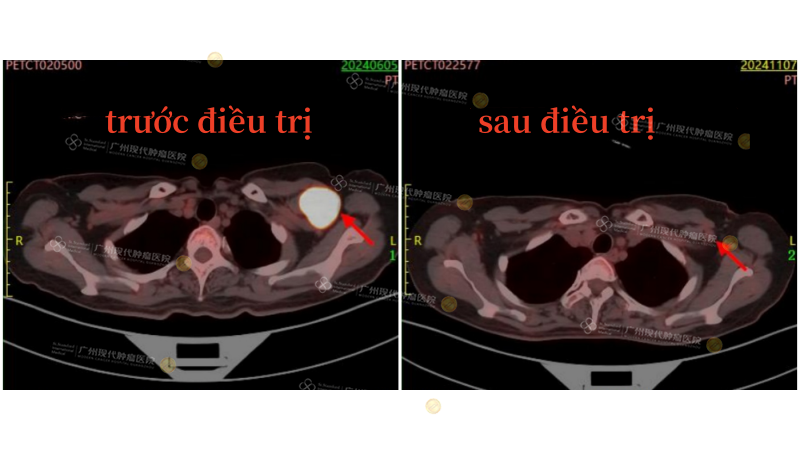 左腋窝肿瘤治疗前后_副本.png
